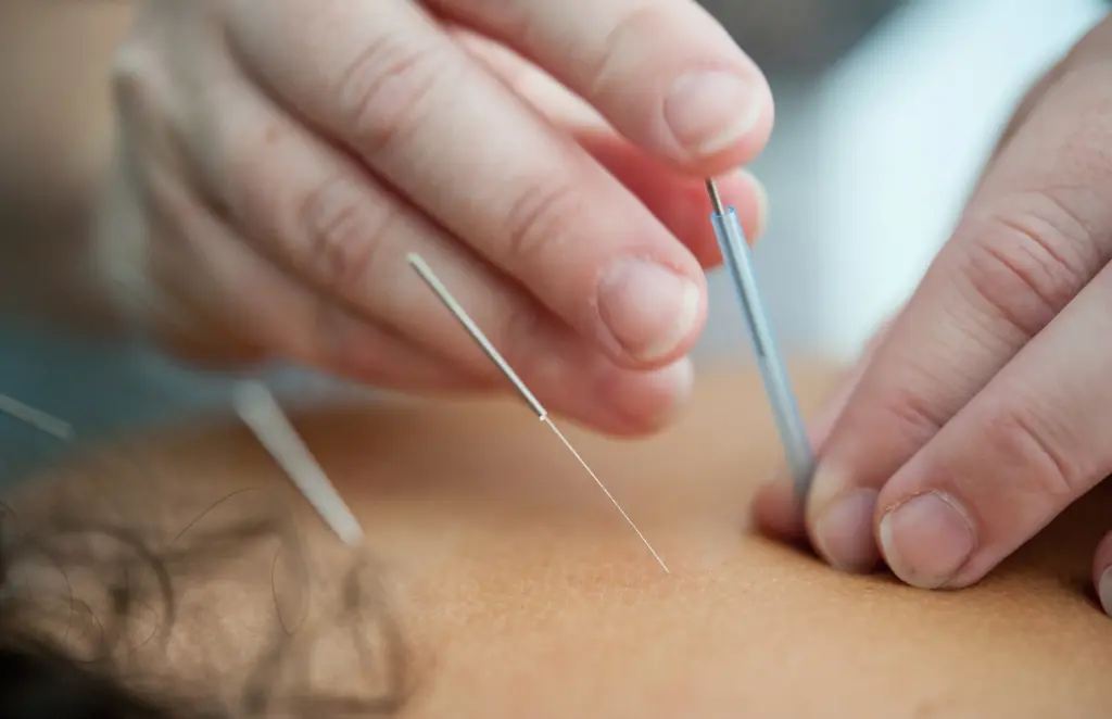 Acupuncture in Traditional Chinese Medicine